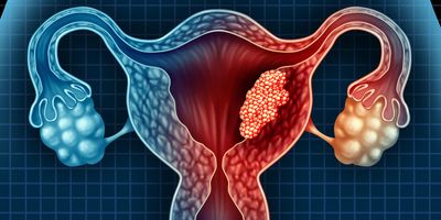 Computer image of a tumor on the uterin wall