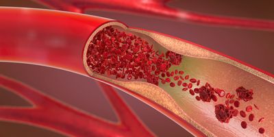 Graphic illustration of an artery, carrying red blood cells, which is narrowing due to accumulation of cholesterol